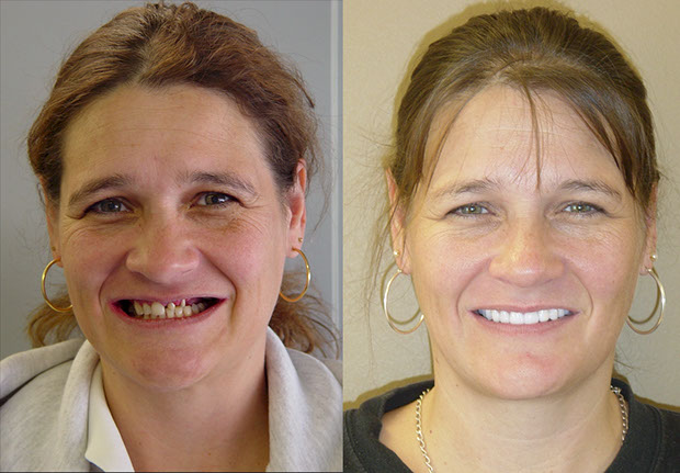 Before and after smile gallery